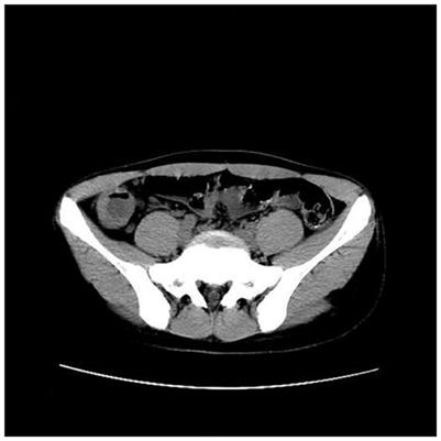 First human case report of Crohn's disease with coexistent acute appendicitis treated by endoscopic retrograde appendicitis therapy
